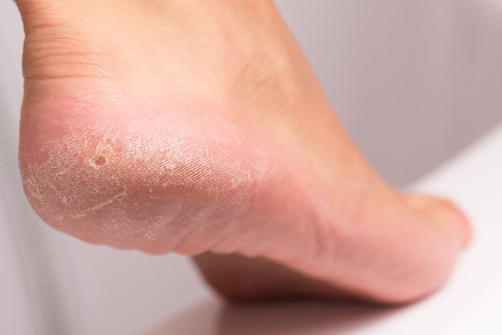 heel hyperkeratosis